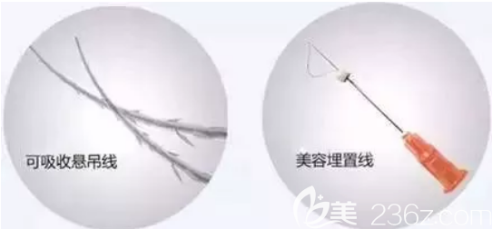 面部埋線提升使用的線材 面部埋線提升使用的線材