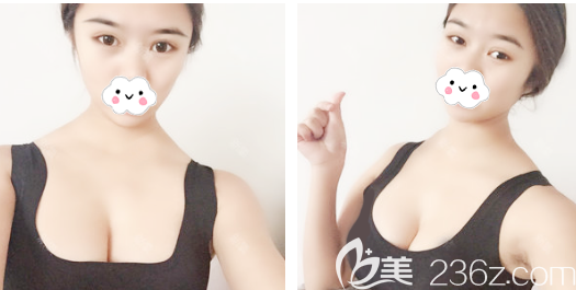 佛山隆胸多少錢？公開我找佛山華美雷朝勇做完假體隆胸后拿到的豐胸價(jià)格表