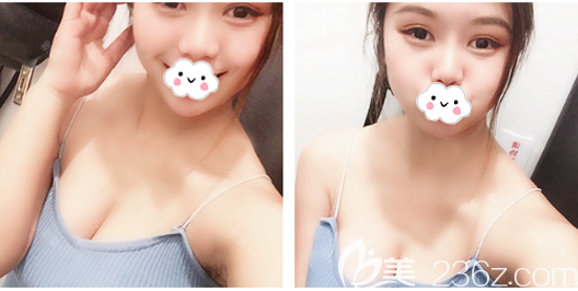 佛山華美雷朝勇院長(zhǎng)假體隆胸案例 佛山華美雷朝勇院長(zhǎng)假體隆胸案例