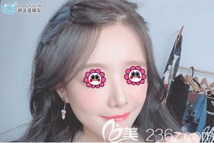 我在北京植發(fā)醫(yī)院排名靠前的北京碧蓮盛種植發(fā)際線后改善了額角光禿等問(wèn)題