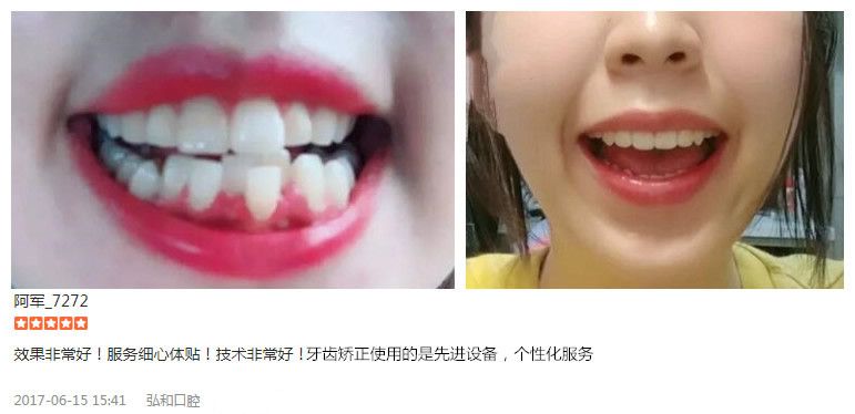 深圳弘和口腔隱形牙齒矯正案例及顧客評價 深圳弘和口腔隱形牙齒矯正案例及顧客評價