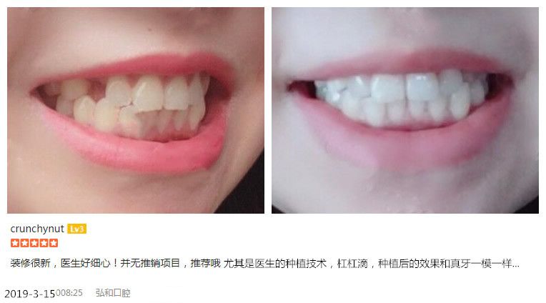 深圳弘和口腔種植牙案例及顧客評價 深圳弘和口腔種植牙案例及顧客評價