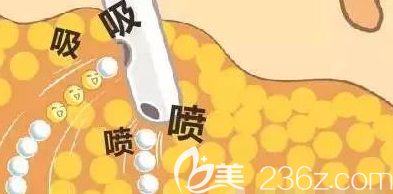 吸脂手術(shù)的原理