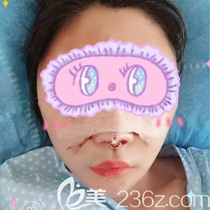 剛做完鼻綜合+脂肪填充術(shù)后恢復(fù)