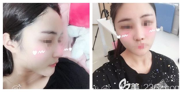 脂肪填充+鼻綜合術(shù)后半個(gè)月恢復(fù)