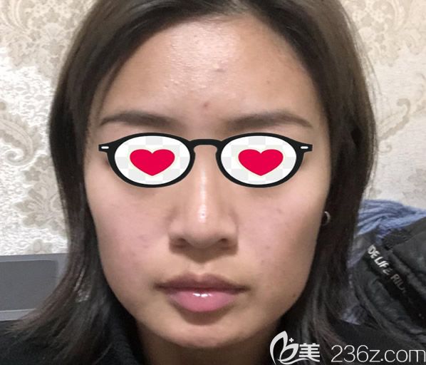 蘭州崔大夫整形徐隴豫醫(yī)生做全臉脂肪填充和硅膠墊下巴前 蘭州崔大夫整形徐隴豫醫(yī)生做全臉脂肪填充和硅膠墊下巴前