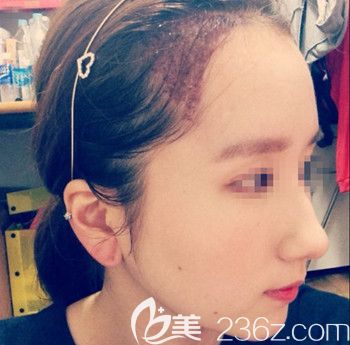 在韓國forhair做無切開發(fā)際線移植術(shù)后1天 在韓國forhair做無切開發(fā)際線移植術(shù)后1天