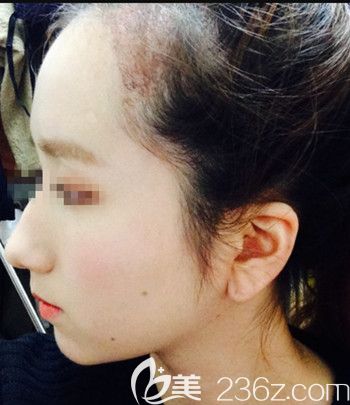 在韓國forhair做無切開發(fā)際線移植術(shù)后1個(gè)月 在韓國forhair做無切開發(fā)際線移植術(shù)后1個(gè)月