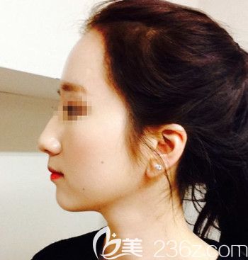 在韓國forhair做無切開發(fā)際線移植術(shù)后4個(gè)月 在韓國forhair做無切開發(fā)際線移植術(shù)后4個(gè)月