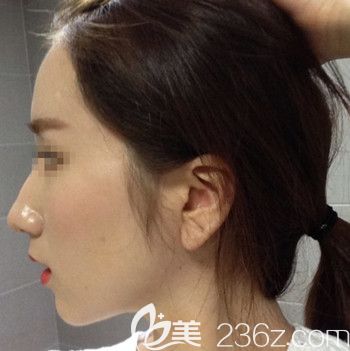 在韓國forhair做無切開發(fā)際線移植術(shù)后7個(gè)月 在韓國forhair做無切開發(fā)際線移植術(shù)后7個(gè)月