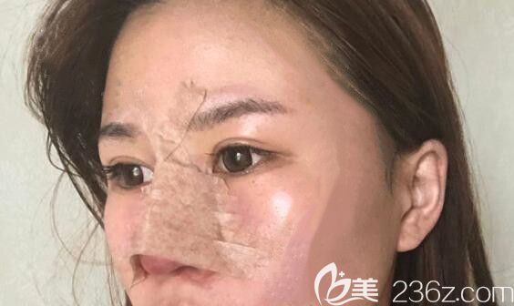 我在太原時(shí)光整形做膨體加自體耳軟骨隆鼻第3天