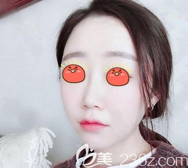 上傳義烏連天美做自體脂肪填充5個(gè)月恢復(fù)效果圖片,醫(yī)院操作挺正規(guī)的,價(jià)格也合理