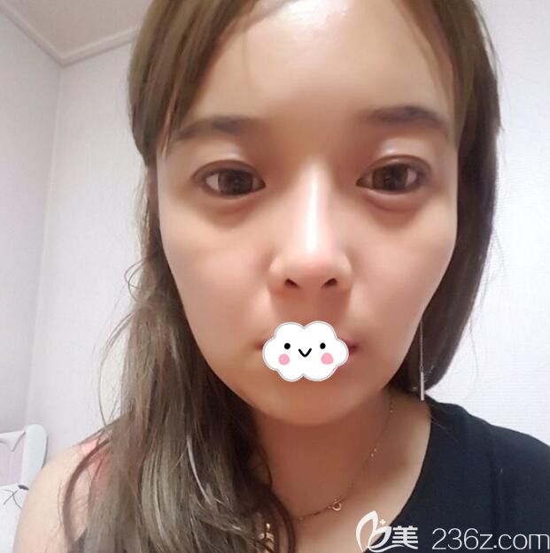 韓國eu整形醫(yī)院金鐘潤面部輪廓三件套真人案例 韓國eu整形醫(yī)院金鐘潤面部輪廓三件套真人案例