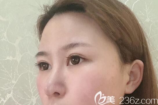 我在太原時(shí)光整形做鼻綜合隆鼻術(shù)后第15天