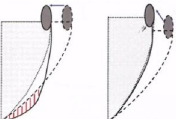 顴骨下垂的示意圖
