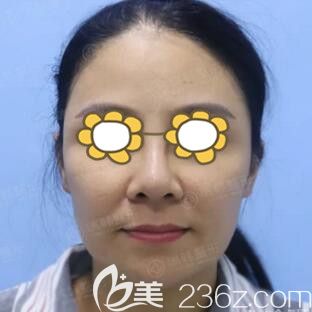 做面部埋線提升術(shù)前照 做面部埋線提升術(shù)前照