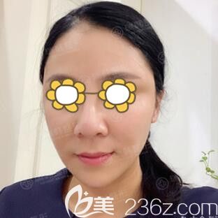 在瑞韓做完面部埋線提升術(shù)后2天效果 在瑞韓做完面部埋線提升術(shù)后2天效果