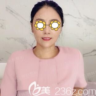 在海南瑞韓做完面部線雕提升術(shù)后3天效果圖 在海南瑞韓做完面部線雕提升術(shù)后3天效果圖