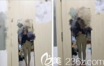 大腿環(huán)吸術(shù)后2個(gè)月的樣子