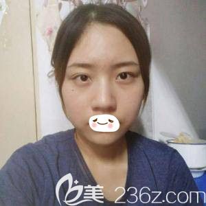 在張家口維多利亞注射玻尿酸術(shù)前面部凹陷 在張家口維多利亞注射玻尿酸術(shù)前面部凹陷