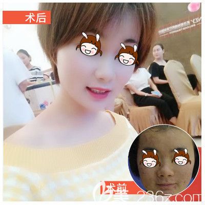 壹加壹清痘術(shù)前術(shù)后對比圖