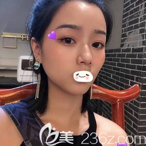 內(nèi)雙做哪種雙眼皮好?可以參考我在張家口維多利亞做全切雙眼皮術(shù)后變5mm自然平扇形雙眼皮的效果