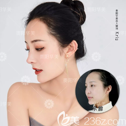 貴陽華美隆鼻好不好