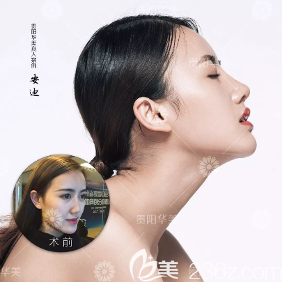 貴州華美隆鼻案例