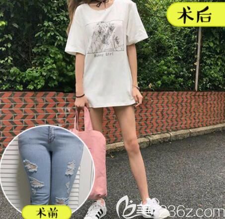 壹加壹李杰注射瘦腿案例前后效果對(duì)比