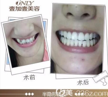 蕪湖哪里牙齒矯正好？壹加壹半隱形牙齒矯正案例前后效果對(duì)比