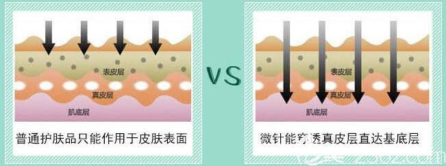張春明醫(yī)生分享微針治療效果 張春明醫(yī)生分享微針治療效果