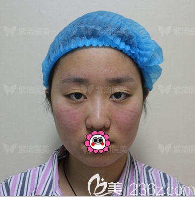 我在北京紫潔儷方醫(yī)療美容做定點(diǎn)雙眼皮前樣子 我在北京紫潔儷方醫(yī)療美容做定點(diǎn)雙眼皮前樣子