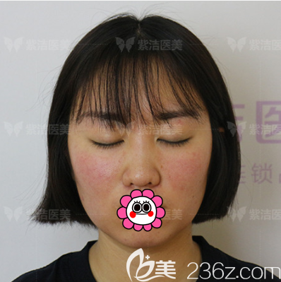 張金娥醫(yī)生給我做定點(diǎn)雙眼皮第5天樣子 張金娥醫(yī)生給我做定點(diǎn)雙眼皮第5天樣子