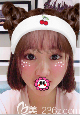 北京紫潔醫(yī)美定點(diǎn)雙眼皮案例 北京紫潔醫(yī)美定點(diǎn)雙眼皮案例