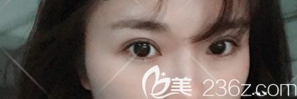 周其光醫(yī)生在醫(yī)院坐診了,看我找周其光割雙眼皮后恢復(fù)的怎么樣,效果好嗎