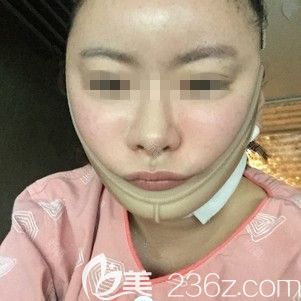 在韓國(guó)ARTLINE做面部吸手術(shù)當(dāng)天 在韓國(guó)ARTLINE做面部吸手術(shù)當(dāng)天