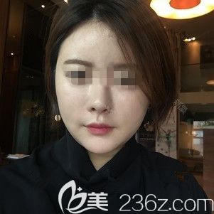 在韓國(guó)ARTLINE做面部吸術(shù)后2周 在韓國(guó)ARTLINE做面部吸術(shù)后2周