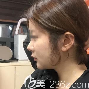 在韓國(guó)ARTLINE做面部吸術(shù)后1個(gè)月 在韓國(guó)ARTLINE做面部吸術(shù)后1個(gè)月