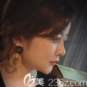 分享自己在?韓國ARTLINE整形醫(yī)院做面部吸的脂親身經(jīng)歷 術(shù)后半年恢復(fù)過程圖變化好大 