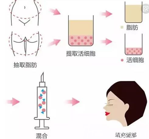 紹興維美脂肪微分3.0手術(shù)過程示意圖