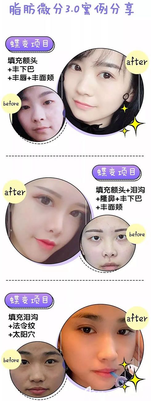 紹興維美脂肪微分3.0填充案例