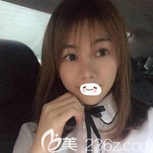 遺傳單眼皮+面部凹陷讓我很煩惱 沒想到找張家口維多利亞姜濤醫(yī)生做了全切雙眼皮術(shù)和自體脂肪填充面部后效果如同換臉