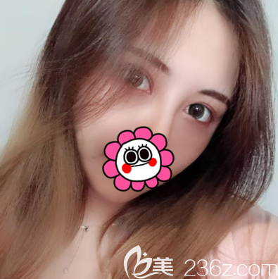 我在北京壹加壹做埋線雙眼皮第15天效果