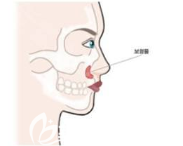 假體墊鼻基底的示意圖