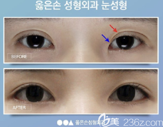 韓國righthand整形金英民做眼睛怎么樣