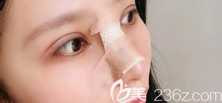 做完雙眼皮和隆鼻即刻<span style=