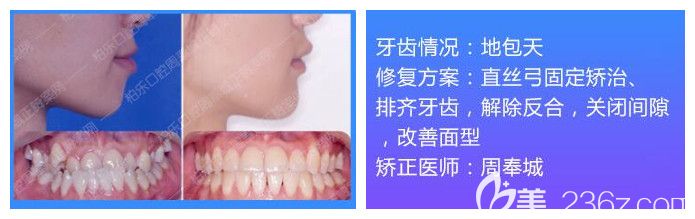 南寧柏樂口腔牙齒矯正案例