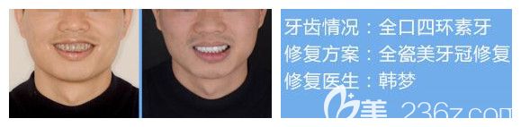 南寧柏樂口腔牙齒美白案例