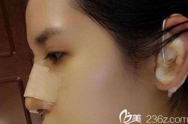 肋軟骨隆鼻第7天拆線呼吸順暢多了