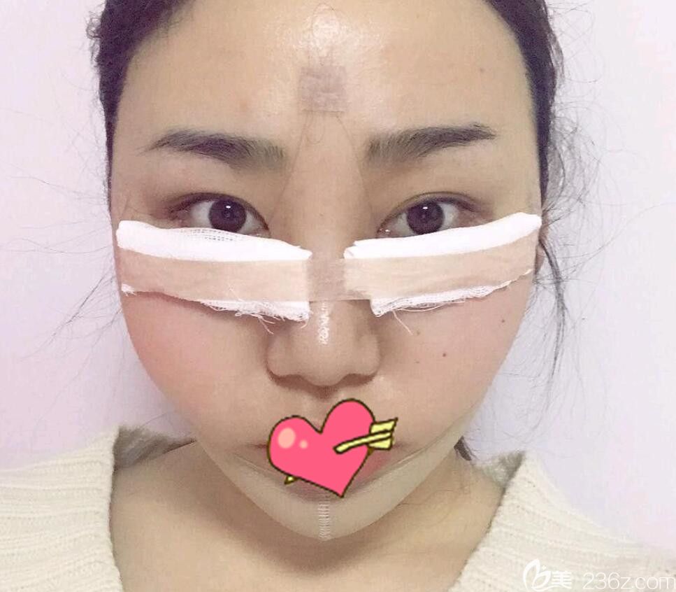 安徽韓美做面部吸脂+埋線提升+祛眼袋術(shù)后當天 安徽韓美做面部吸脂+埋線提升+祛眼袋術(shù)后當天